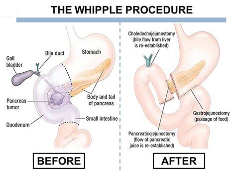 Understanding the Surgical Whipple Procedure for Pancreatic Health