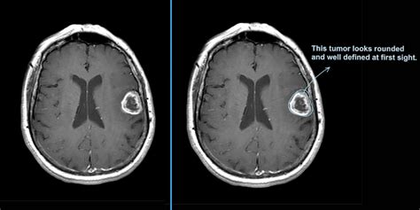 surviving glioblastoma multiforme brain tumor