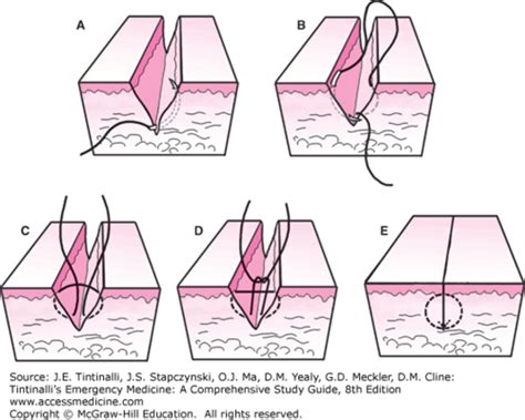 Suture Removal Quizlet