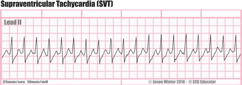 svt - supraventricular tachycardia