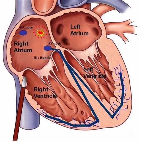 svt ablation procedure