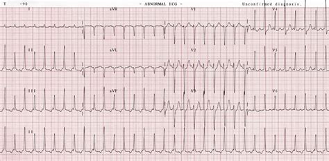 svt ekg findings