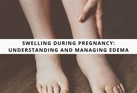 Managing Swelling During Pregnancy: Causes and Effective Relief Methods