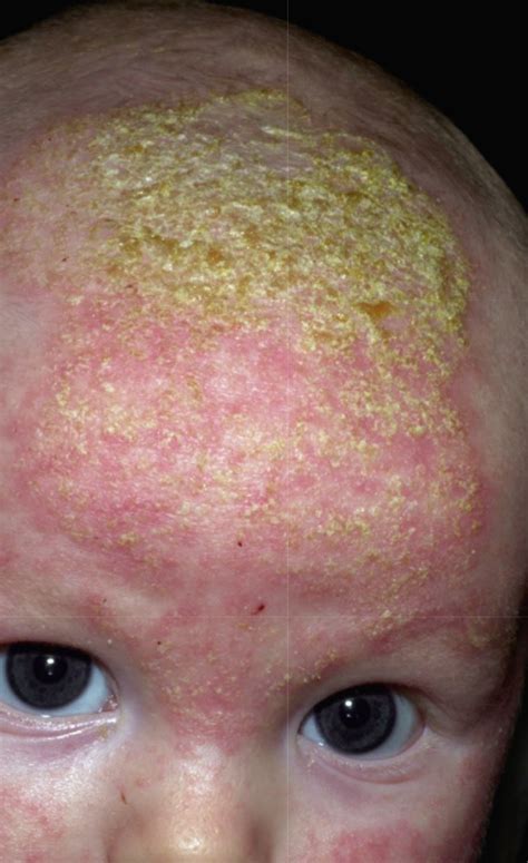 Swim Cap Dermatitis