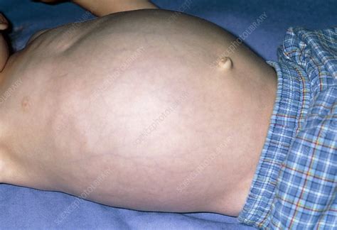Swollen Abdomen