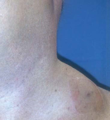 swollen area between neck and collarbone