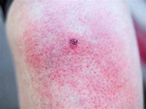 Swollen Bug Bite