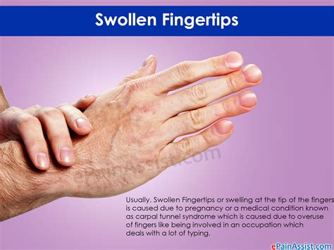 Swollen Fingertips Fever