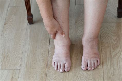 swollen legs in elderly