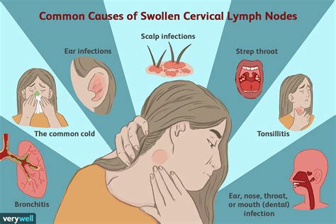 Swollen Lymph Node Treatment: Do Antibiotics Provide Relief?