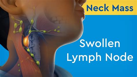 swollen lymph nodes in neck one side painful