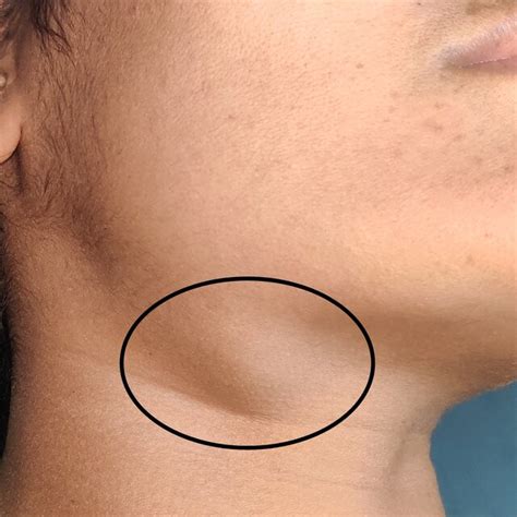 What Causes a Swollen Submandibular Lymph Node: Symptoms, Treatment, and When to Seek Help