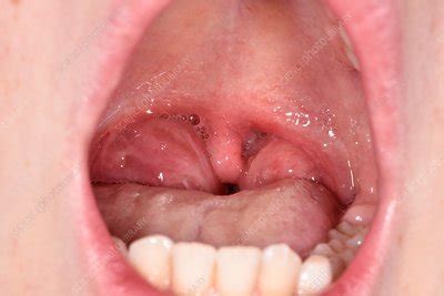 swollen tonsils in toddlers