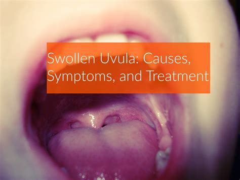What Causes a Swollen Uvula: Surprising Facts Revealed