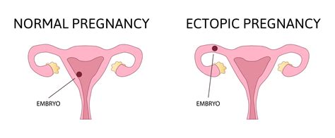 sx of ectopic pregnancy