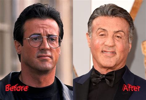 sylvester stallone face surgery