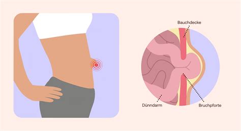Symptômes de l'Hernie Ombilicale