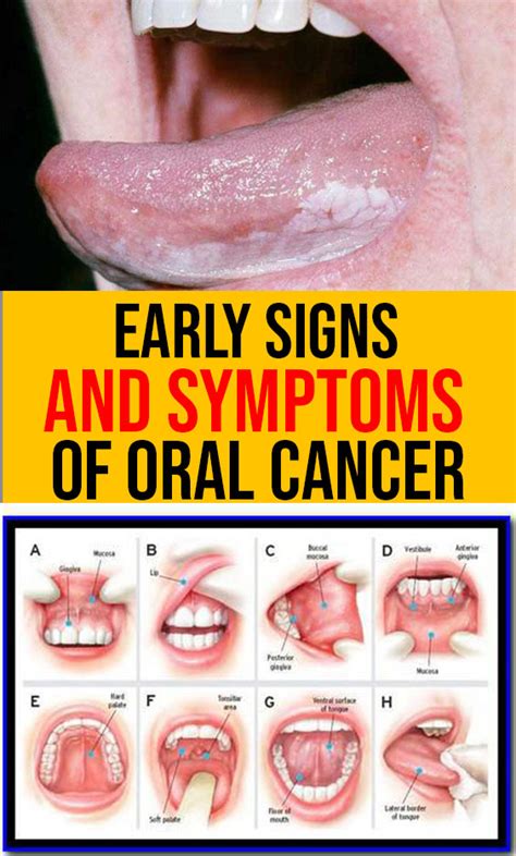 Oral Cancer Symptoms of Oral Cancer (Mouth Cancer) YouTube