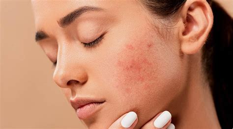 Acne Prone Hindi Meaning / Acne Prone Skin Meaning In