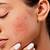 symptoms of acne in hindi