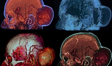 Meningioma Brain Tumor The Most Common Symptoms That You