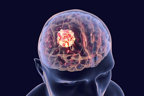Basics of Brain Tumors Johns Hopkins Medicine Health Library