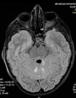 Symptoms Of Brain Tumor Near Optic Nerve