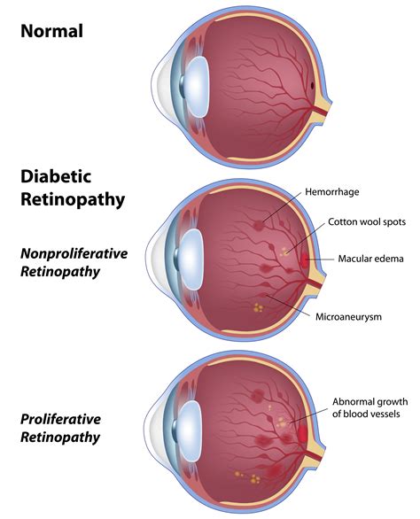 Symptoms Of Diabetes Related Eye Problems