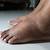 symptoms of diabetes swollen feet