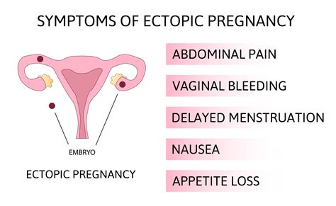 Ectopic Pregnancy Symptoms Be aware 1symptoms