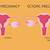 symptoms of ectopic pregnancy in ovary