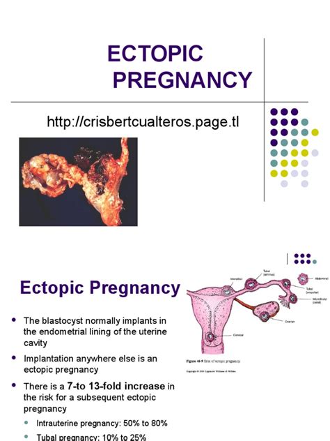 Ectopic Pregnancy Signs & Symptoms, Diagnosis & Treatment