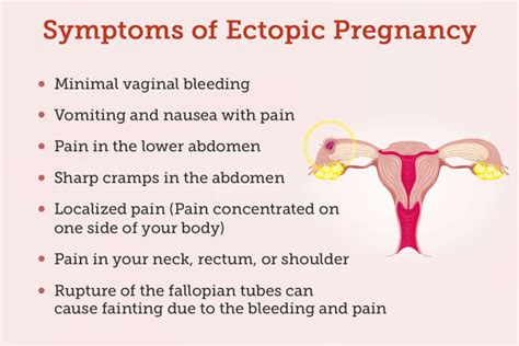Ectopic Pregnancy and Mirena IUD Lawsuits Initiated