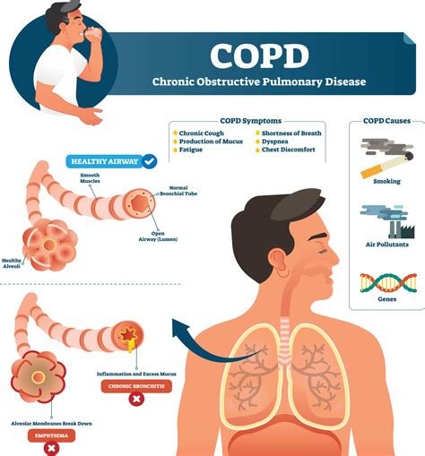 Exacerbation of respiratory symptoms in COPD patients may