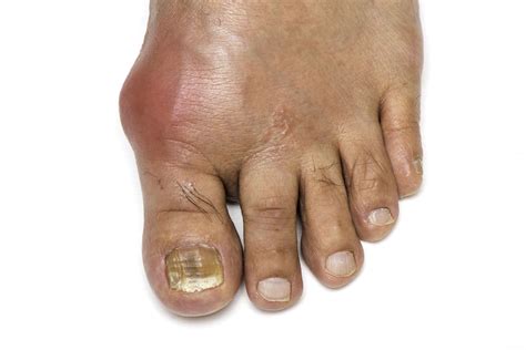 The Gout Code Really Work or Not? My Review