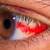 symptoms of high blood pressure red eyes