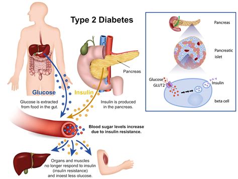 Type 1 Diabetes (Juvenile Diabetes or Insulin Dependent