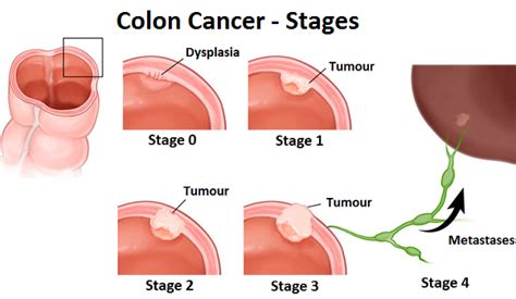 symptoms for stage 3 and 4 colon cancer