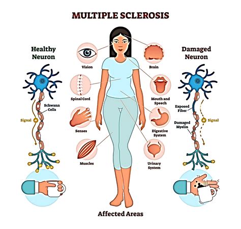 symptoms multiple sclerosis disease