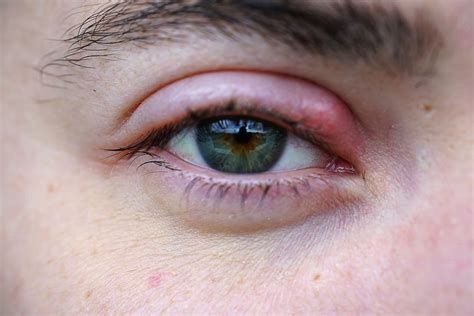 symptoms of a stye on your eyelid