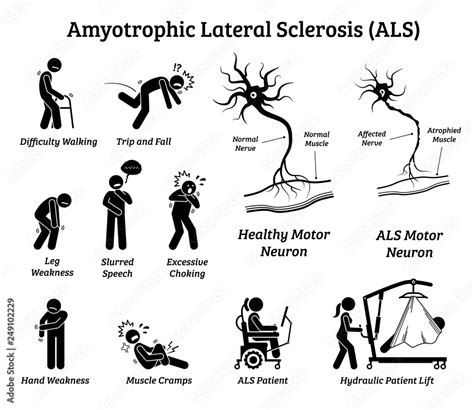 symptoms of als in males