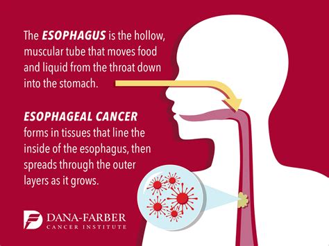 symptoms of cancer in the esophagus