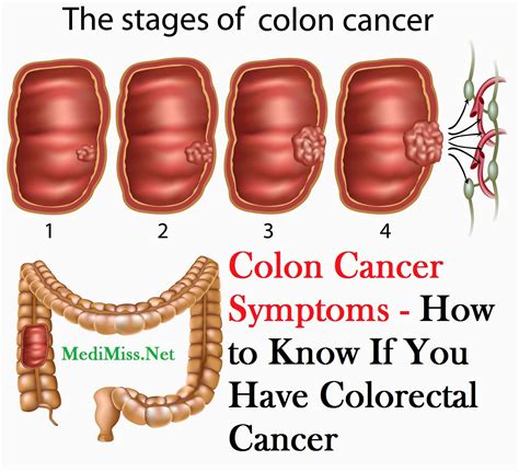 symptoms of colorectal polyps and cancer