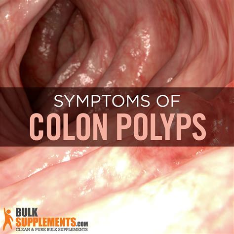 symptoms of having polyps in colon