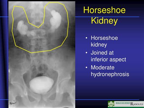 symptoms of horseshoe kidney
