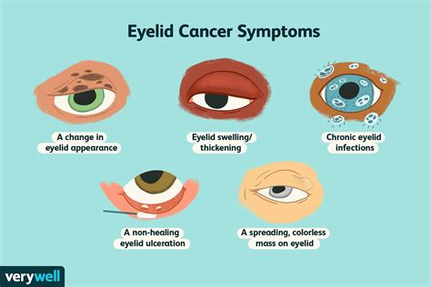 symptoms of ocular cancer