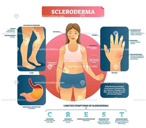 Early Symptoms of Scleroderma Disease You Should Know About