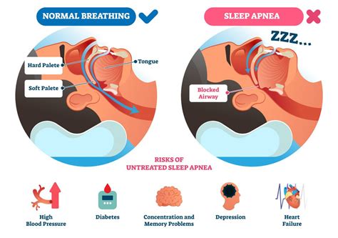 symptoms of sleep apnea during the day