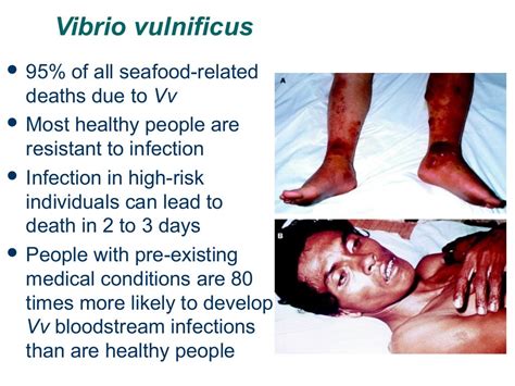 symptoms of vibrio vulnificus