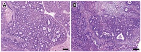 synchronous endometrial and ovarian cancer